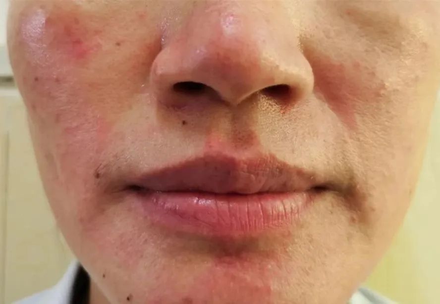 8种类型的面部皮炎,您一定要知道,很多人都有过