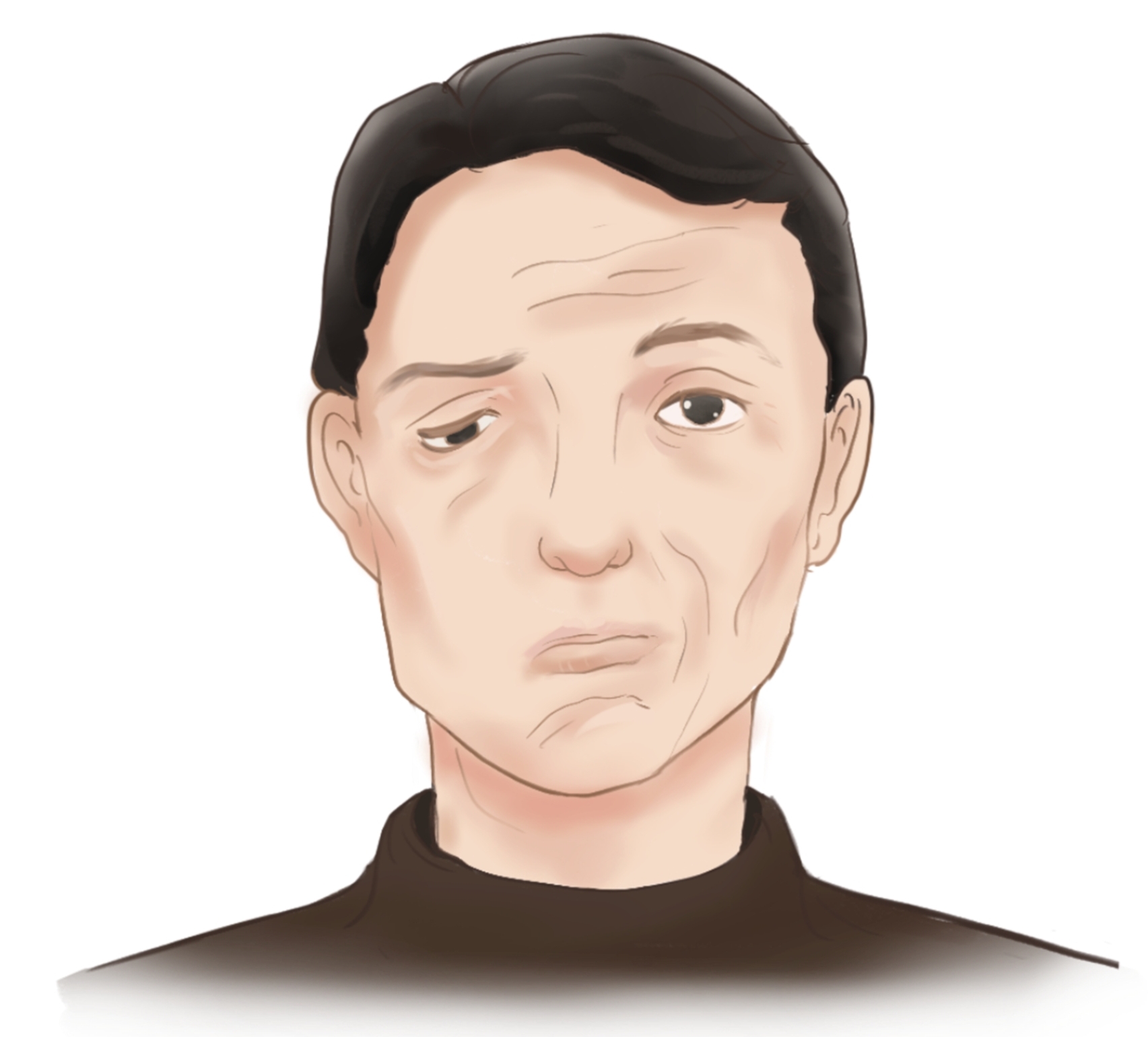 就诊,才发现自己不是中风,而是面瘫!