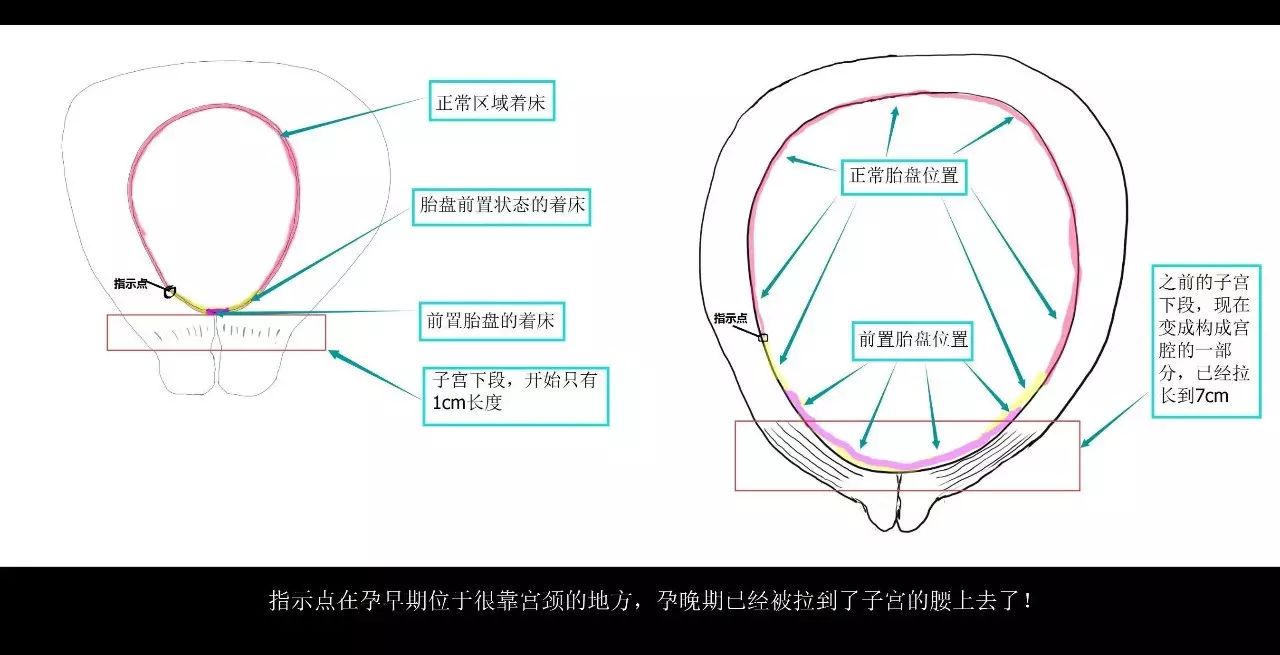 发现胎盘前置状态怎么办