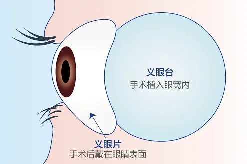 科普 | 关于义眼,你了解多少?