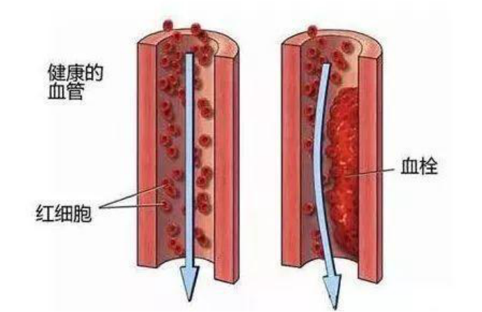 VTE---静脉血栓栓塞症 健康宣教手册